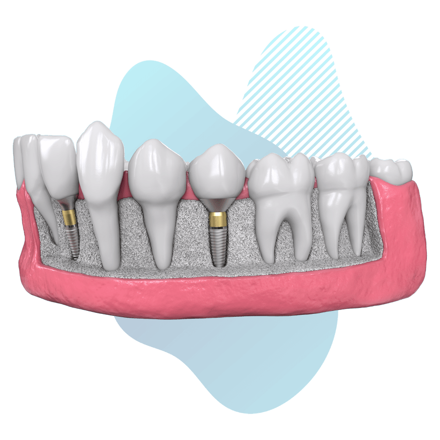 dental bone graft london Forest Hill & Dulwich