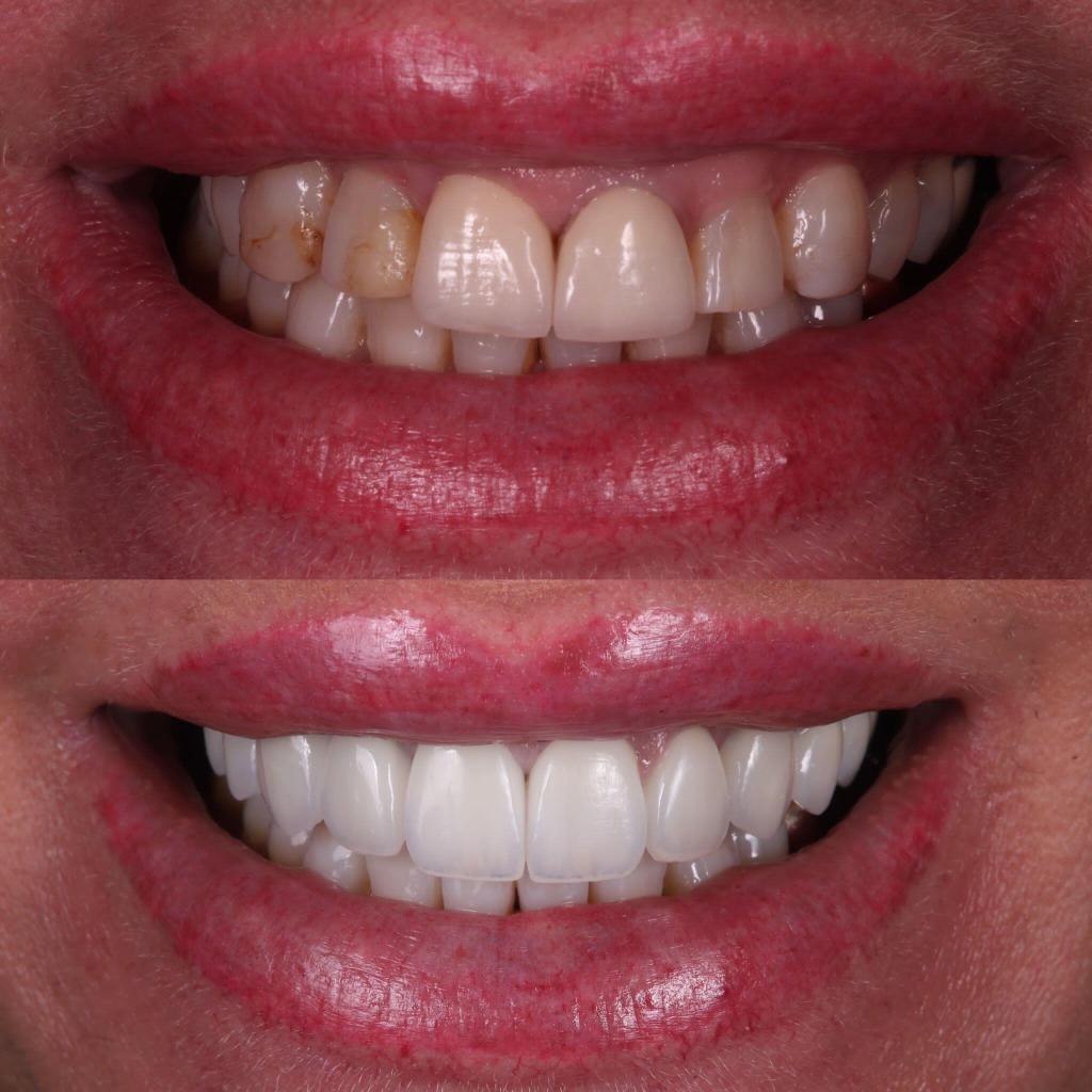 Porcelain Veneers vs. Composite Veneers London Dental Arts
